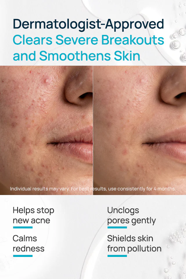 Acne Exfoliating Facial Cream - Image 3