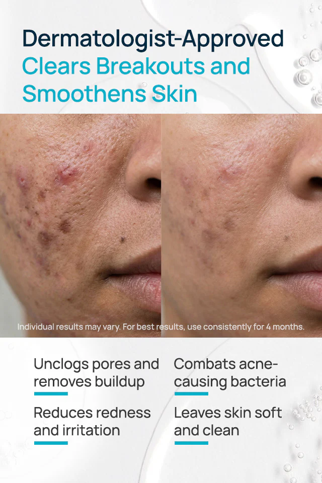 Salicylic Acid And Niacinamide Anti-Acne Face Mask - Image 3