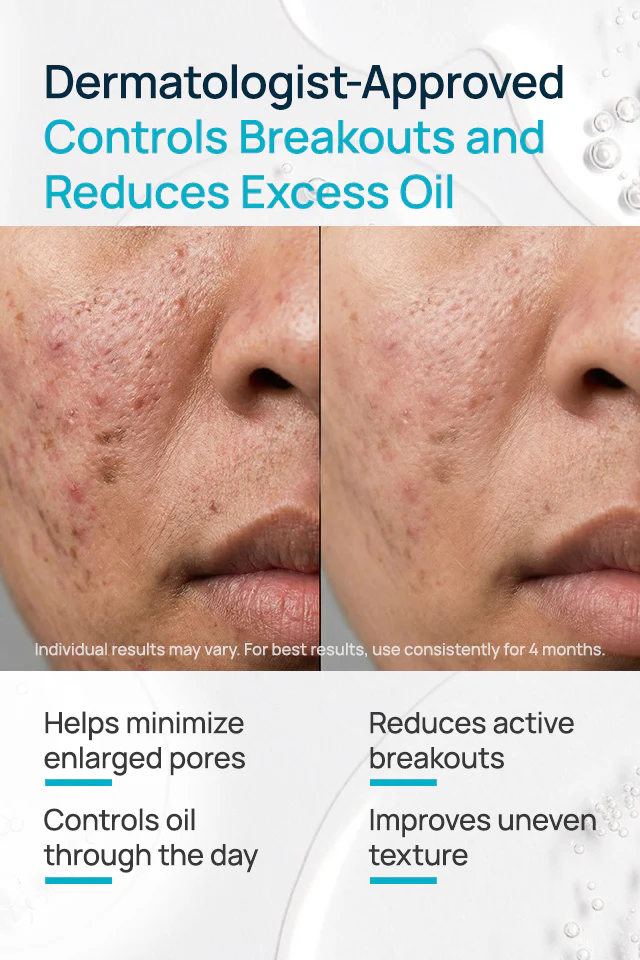 Acne-Limit Facial Cream - Image 3
